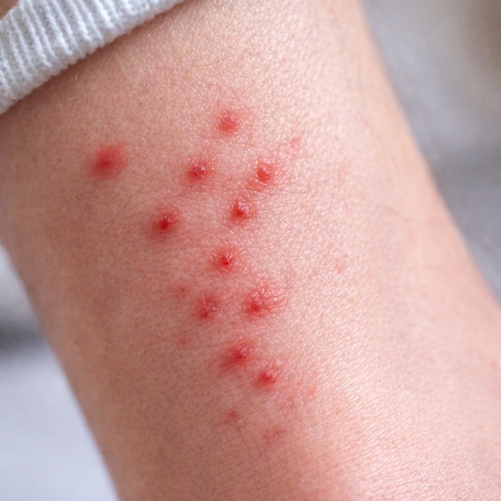 Piqûres de puce sur une cheville