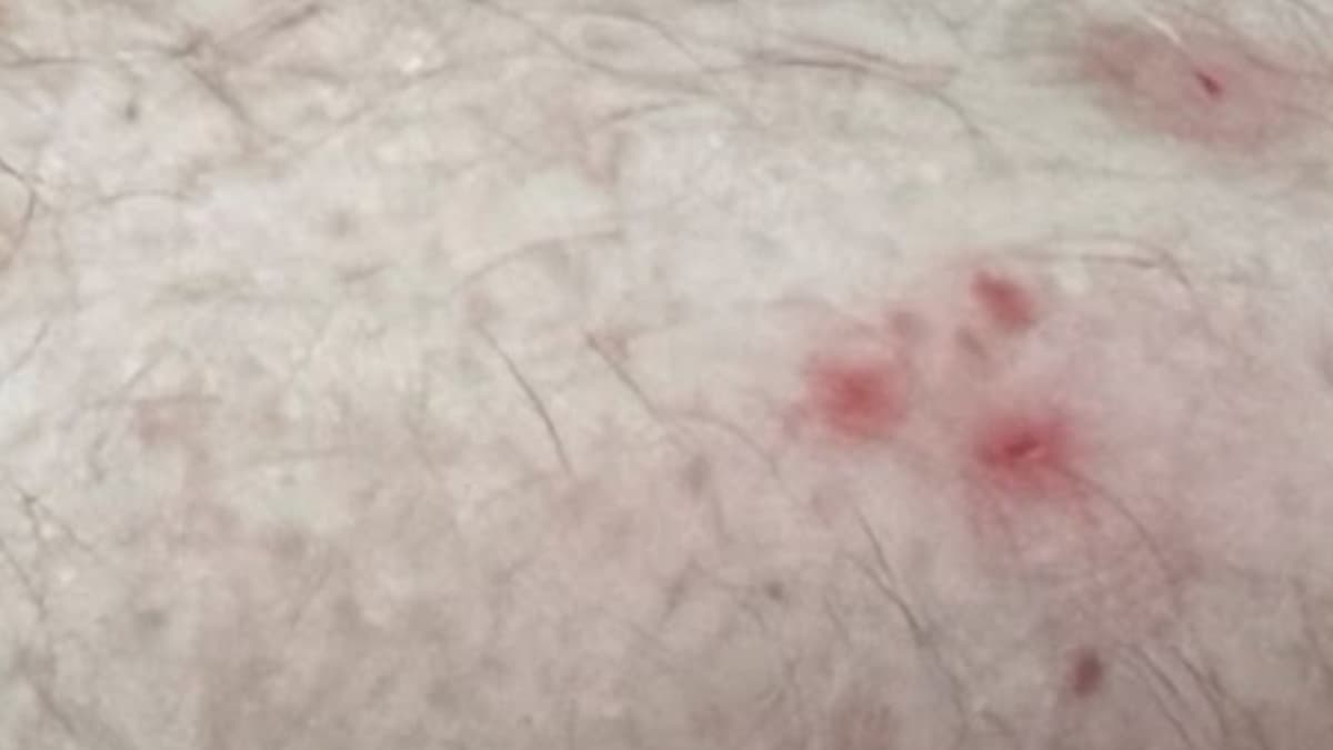 Points de piqûre de punaise de lit sur une jambe
